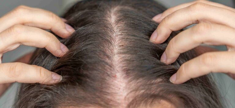Alopecia androgenética tem tratamento: Conheça as opções disponíveis em Joinville.