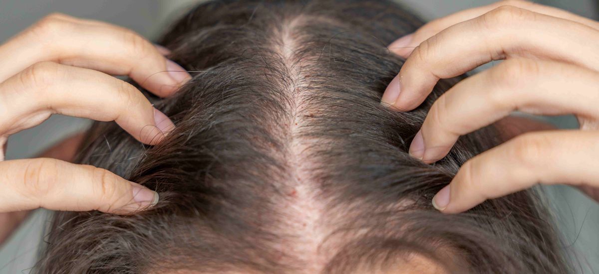 Alopecia androgenética tem tratamento: Conheça as opções disponíveis em Joinville.
